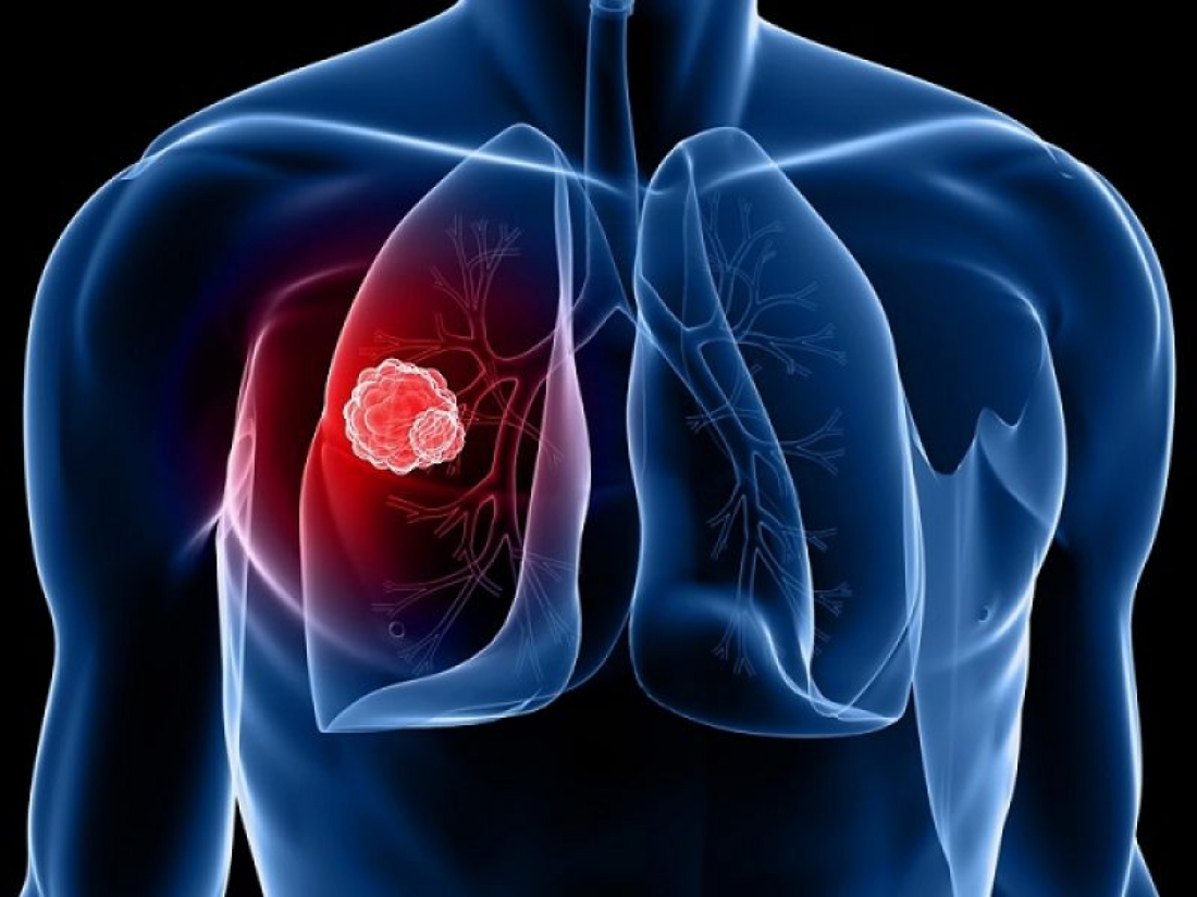 Καρκίνος του Πνεύμονα: Μείωση των θανάτων κατά 25% αν εφαρμοστεί ο προσυμπτωματικός έλεγχος