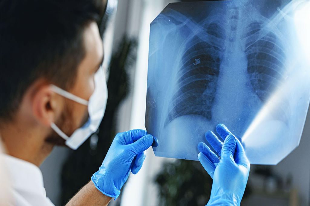 Έρευνα: Ασφαλή τα εμβόλια Covid-19 στους ασθενείς με καρκίνο των πνευμόνων