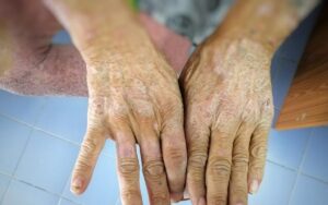 Σκληρόδερμα: Μορφές και θεραπεία