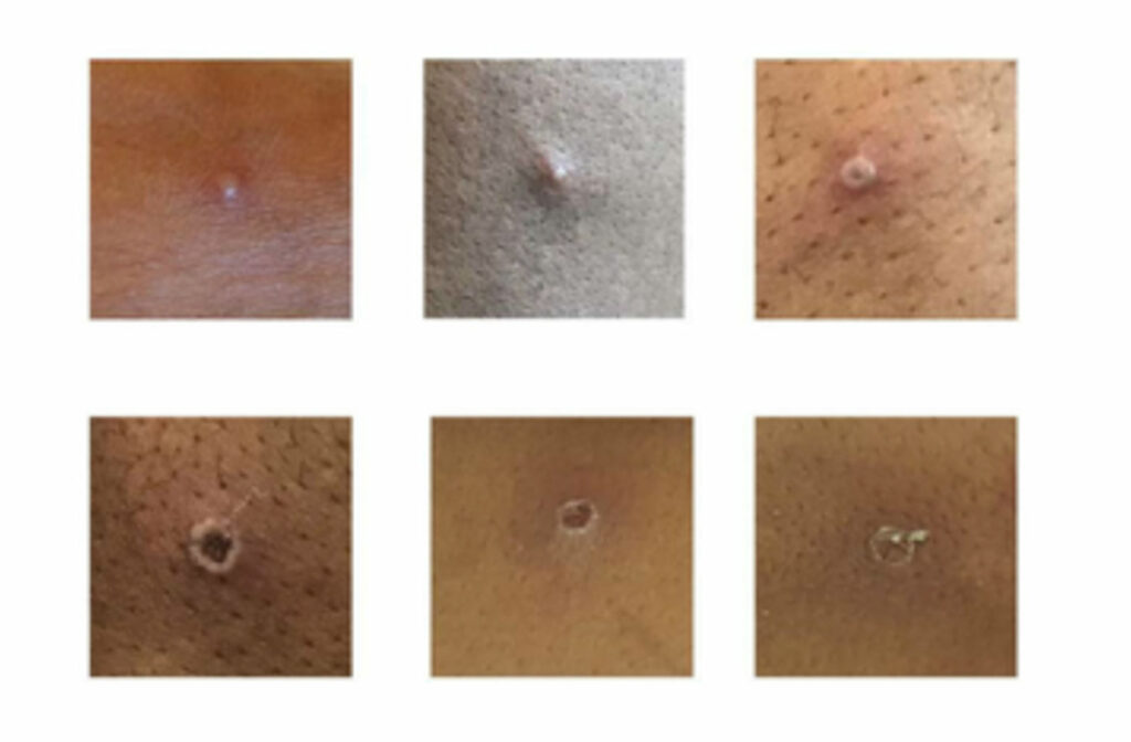 Στα 20 ανήλθαν τα επιβεβαιωμένα κρούσματα της ευλογιάς των πιθήκων στην Ελλάδα