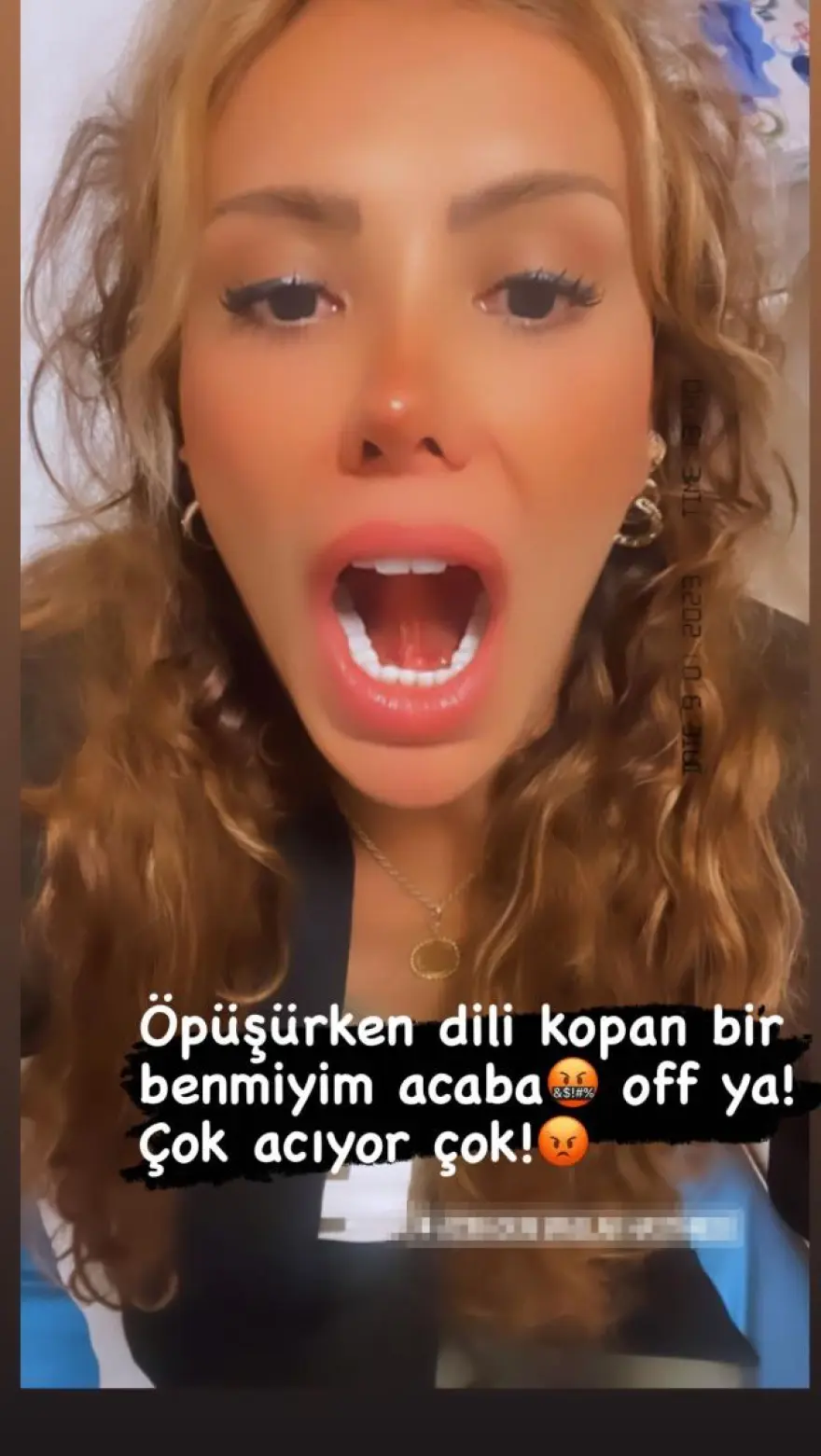Τουρκία: Κατήγγειλε τον σύντροφό της ότι της έκοψε τη γλώσσα με φιλί - «Με φίλησε σαν ζώο»