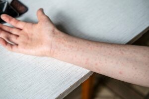 ΗΠΑ: Δεύτερο κοριτσάκι χάνει τη ζωή του από ιλαρά