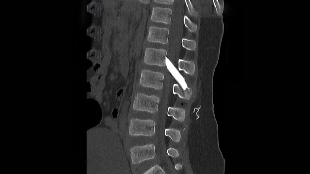 Metropolitan Hospital: Επιτυχής χειρουργική επέμβαση στη σπονδυλική στήλη παιδιού με σοβαρά τραύματα από γυαλί