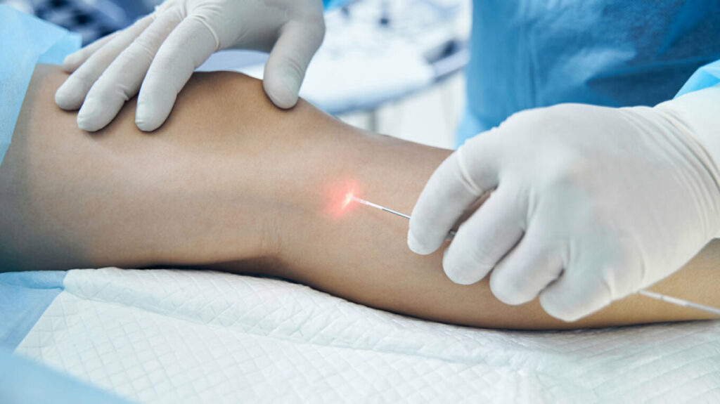 Το μέλλον στη θεραπεία κιρσών και φλεβικής ανεπάρκειας