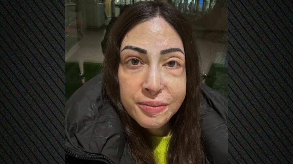 Ιωάννα Παλιοσπύρου: Ανέβασε εικόνες και βίντεο από την αποκατάσταση μετά την επίθεση με βιτριόλι