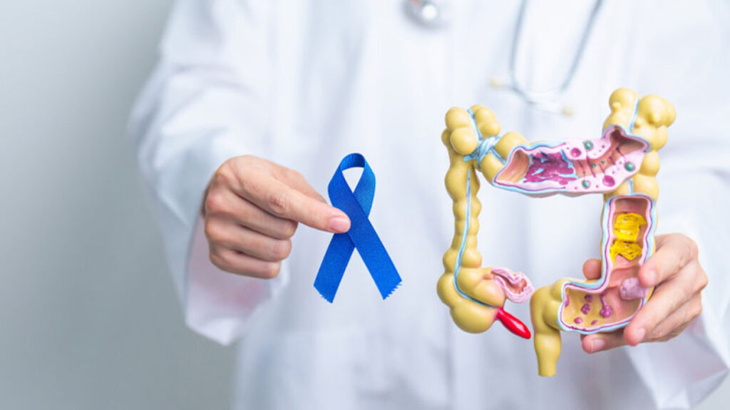 Καρκίνος παχέος εντέρου: Γιατί αυξάνεται στα άτομα κάτω των 50;