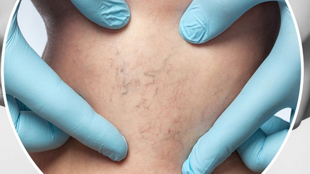 260317144906_sklirotherapeia_arthrou