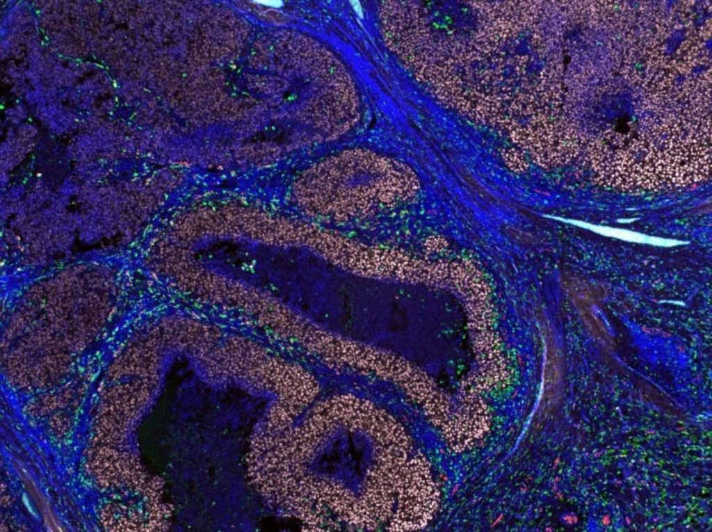 260623144001_human-melanoma-tumour-777×581-1-1024×765